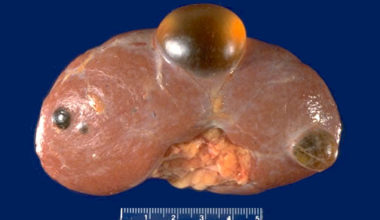 Böbrek Kisti Nedir? Kansere Döner Mi