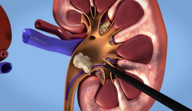 Kapalı Böbrek Taşı Ameliyatı Nedir?