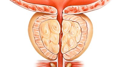 Benign Prostat Hiperplazisi (BPH) Nedir?