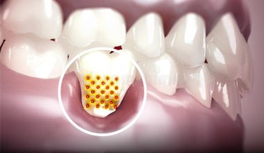 Diş Eti Çekilmesi Neden Olur?