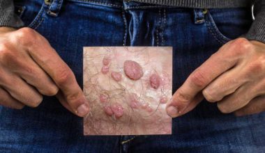 Genital Siğil HPV