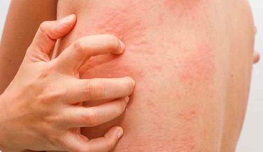 Kaşıntıya Hangi Bölüm Bakar?