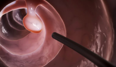 Kolonoskopi Nedir? Nasıl Yapılır?