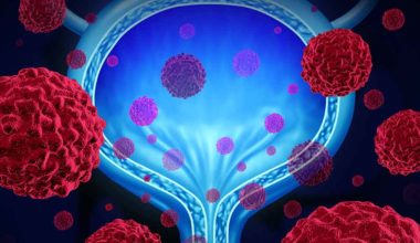 Mesane Kanserinin Belirtileri