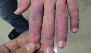 Soğuk Yaralanması Nedir? Belirtileri Nelerdir?