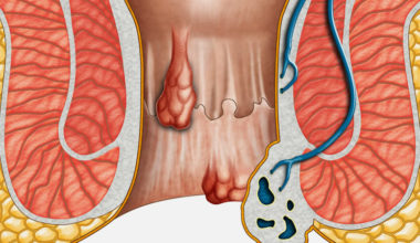 Hemoroid (Basur, Mayasıl)