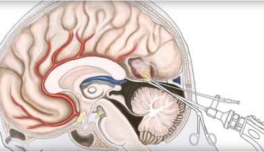 Beyin Omurilik Sinir Cerrahisi