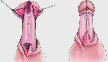 Üretroplasti nedir?