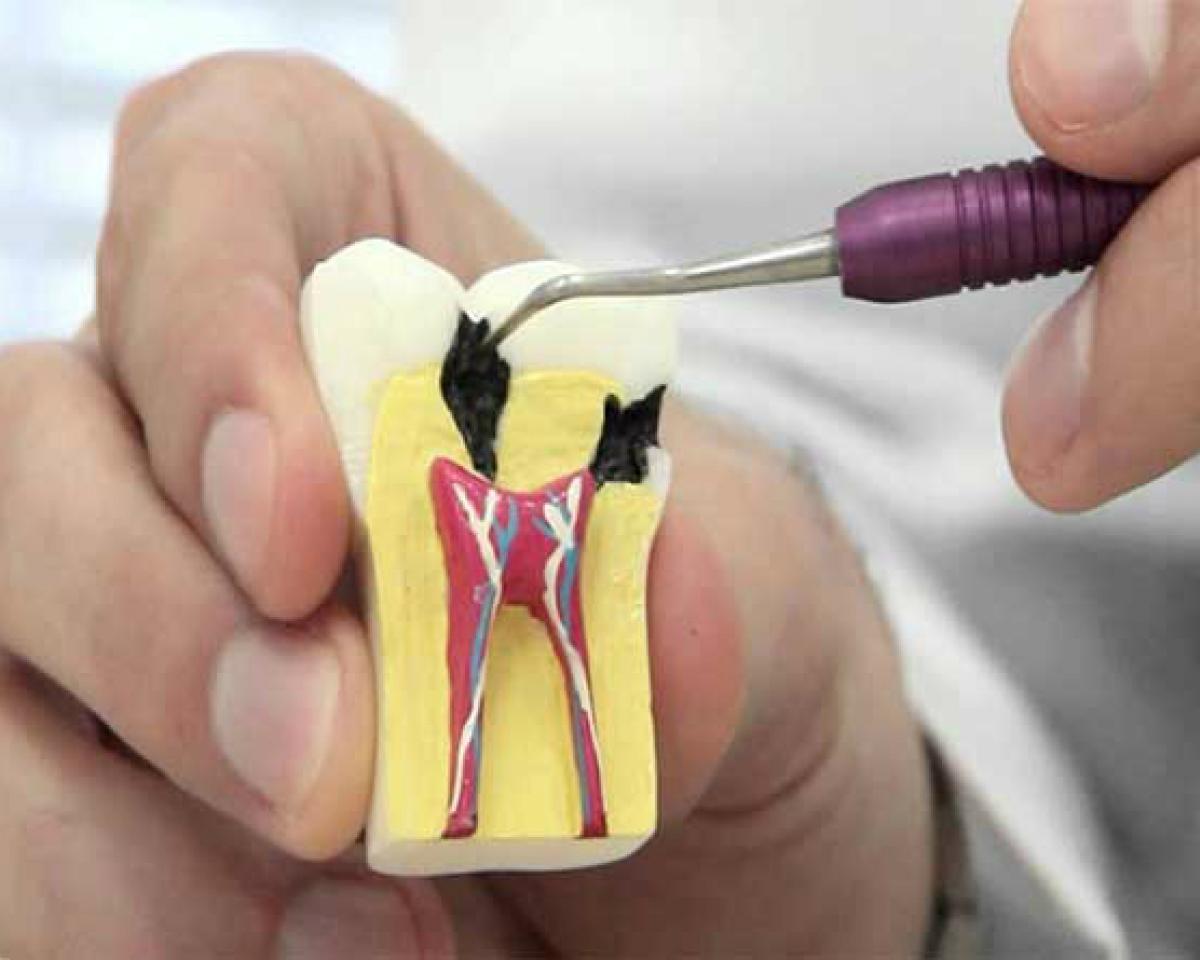 Endodonti Nedir? Neye Bakar? Hastalar Okuyor