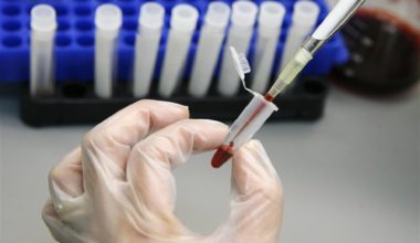 AIDS (HIV) Testi