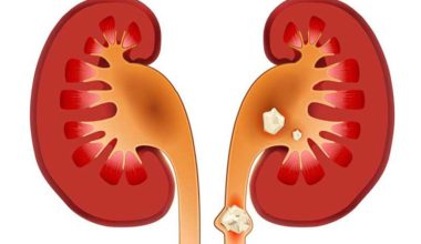 Böbrek Taşı Nedir?