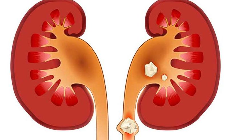 Böbrek Taşı Nedir?