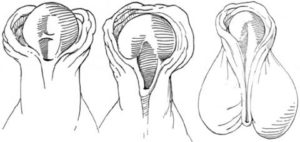 Hipospadiasın Belirtileri 