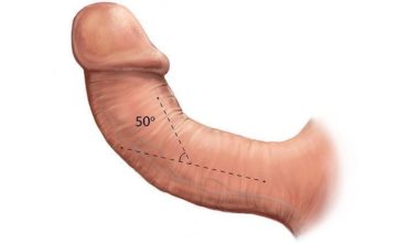Penis Eğriliği Tedavisi