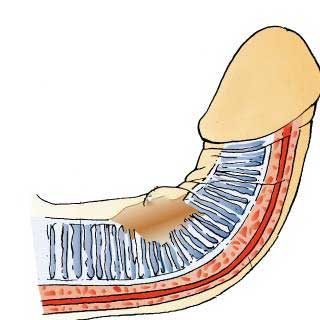 Peyronie hastalığı