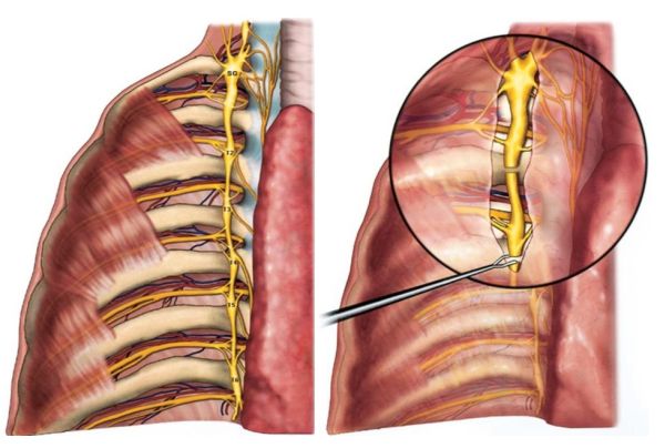 aşırı terleme ameliyatı