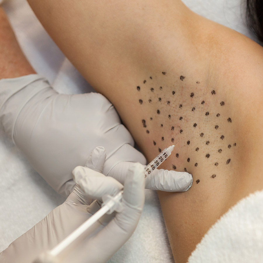 aşırı terlemede botoks tedavisi