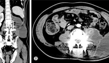 Psoas Apsesi