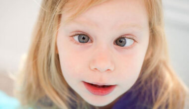 Çocuklarda Şaşılık